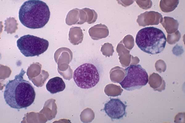 Hoping for an early diagnosis of myeloid leukaemia